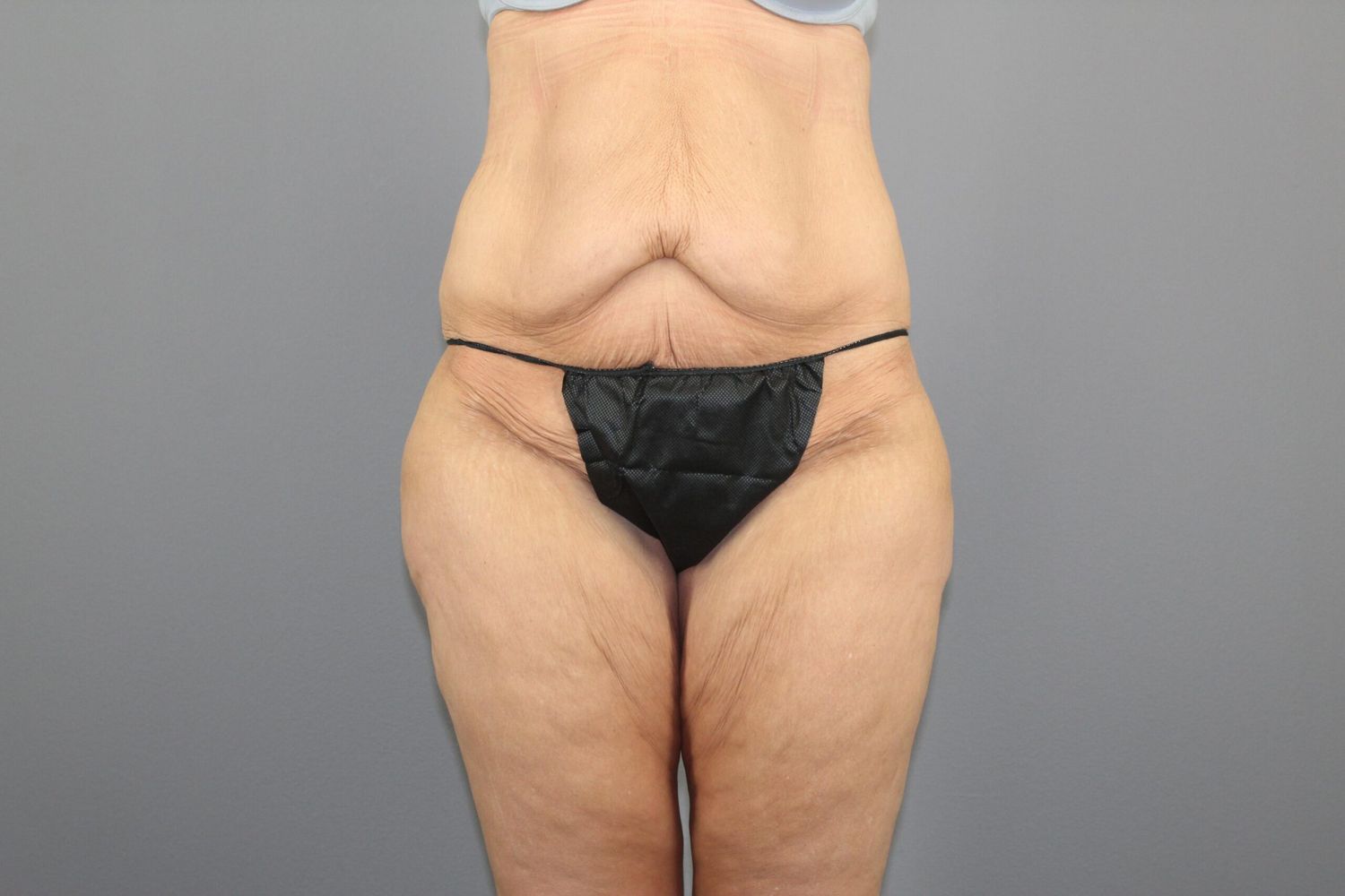 Thigh Lift Before & After