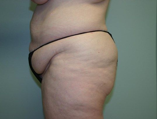 Thigh Lift Before & After