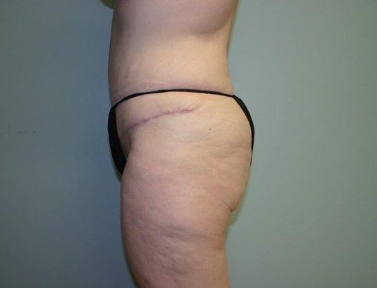 Thigh Lift Before & After
