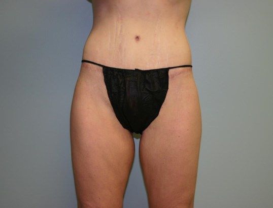 Thigh Lift Before & After