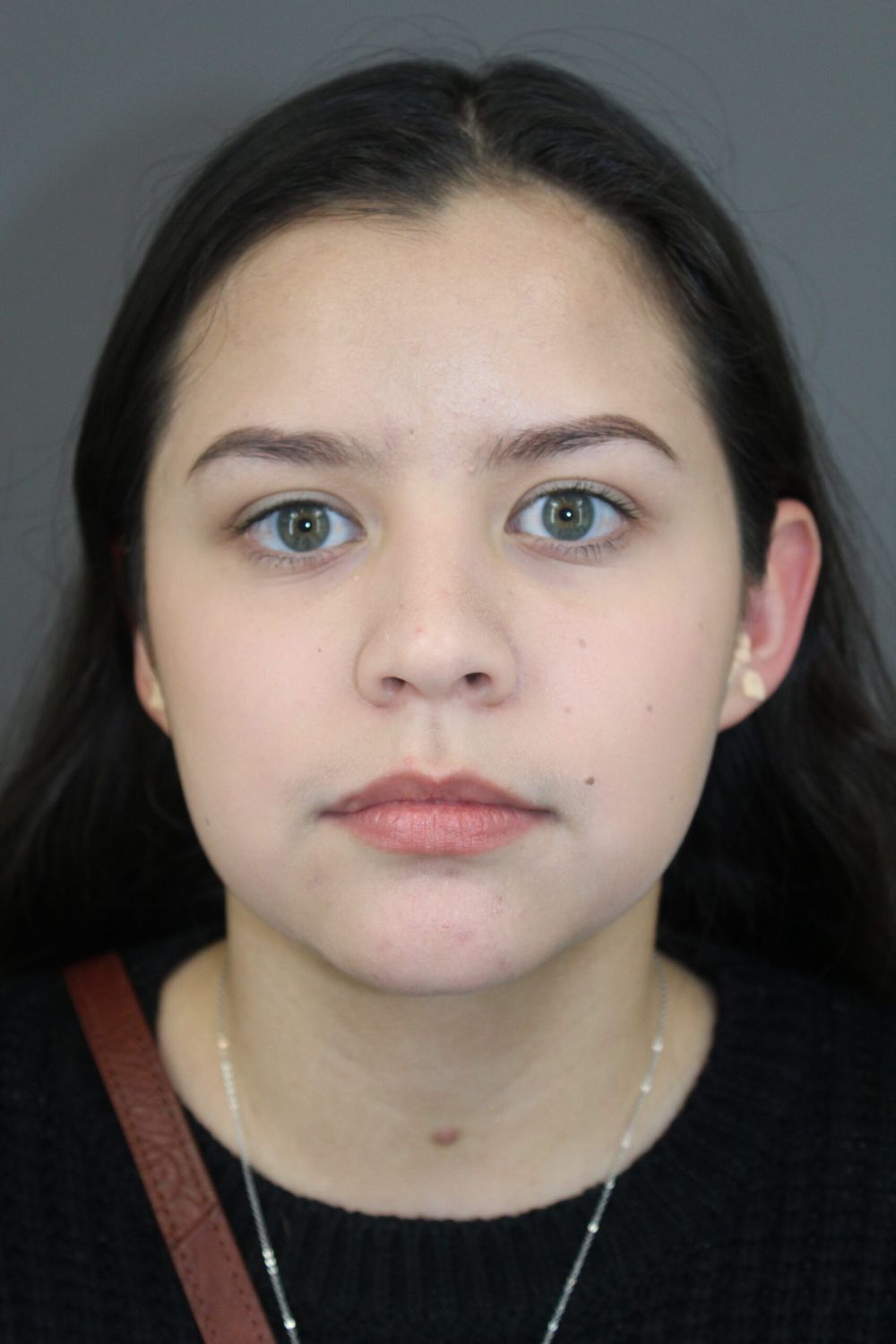 Neck Liposuction Before & After