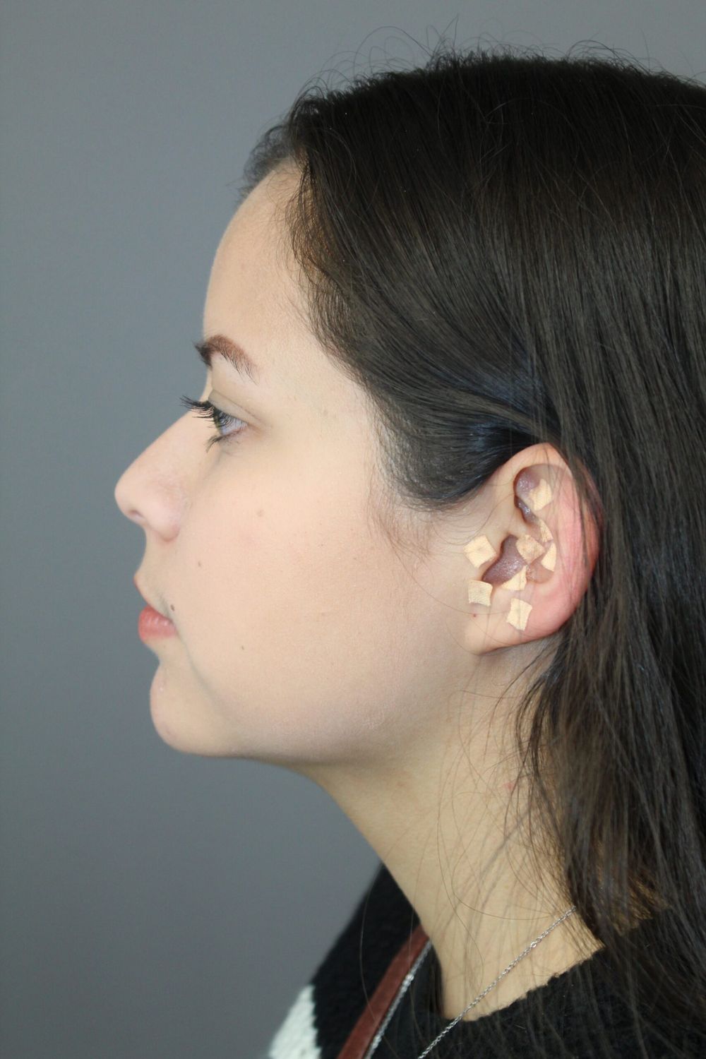 Neck Liposuction Before & After