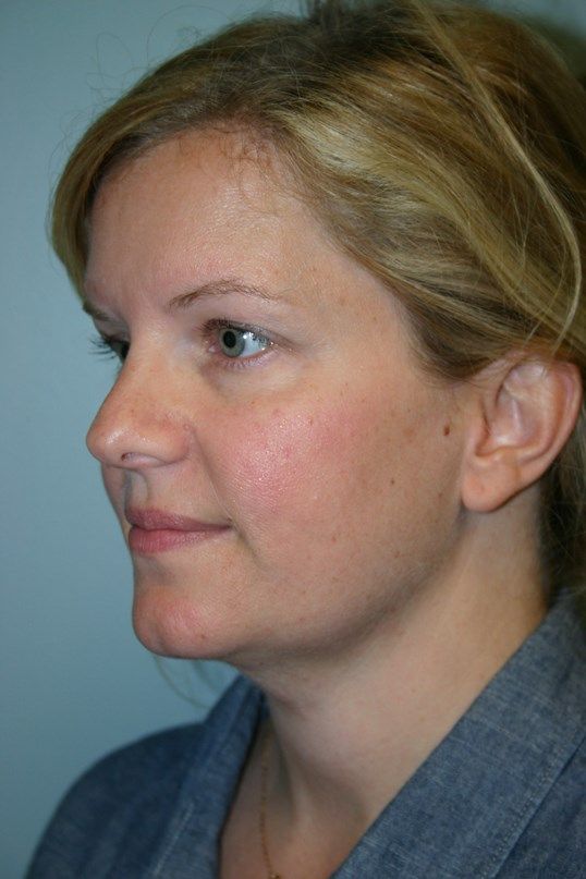 Neck Liposuction Before & After