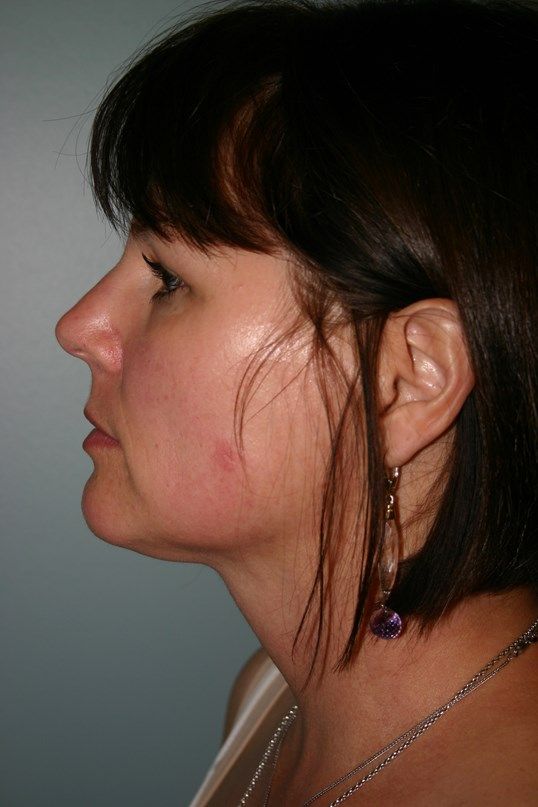 Neck Liposuction Before & After