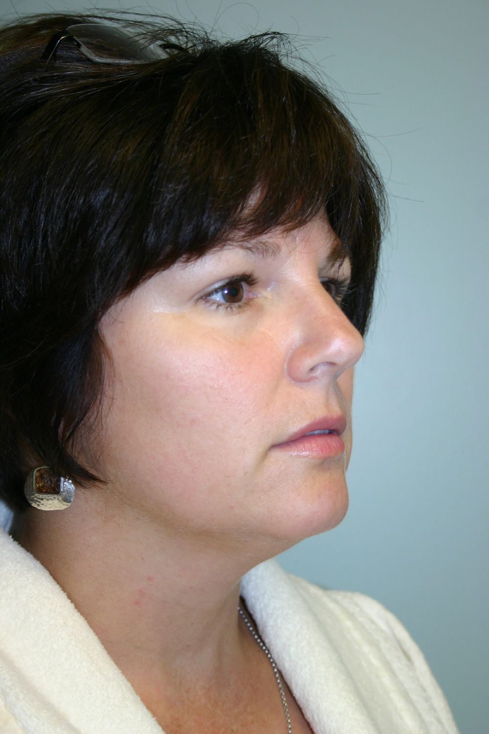 Neck Liposuction Before & After