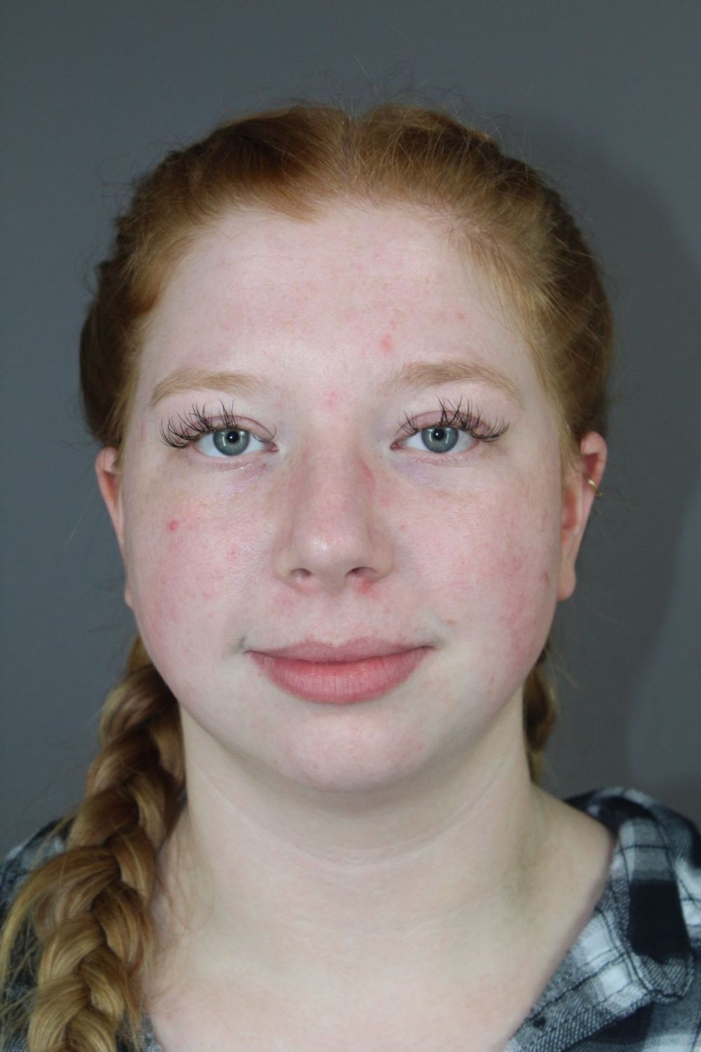 Neck Liposuction Before & After