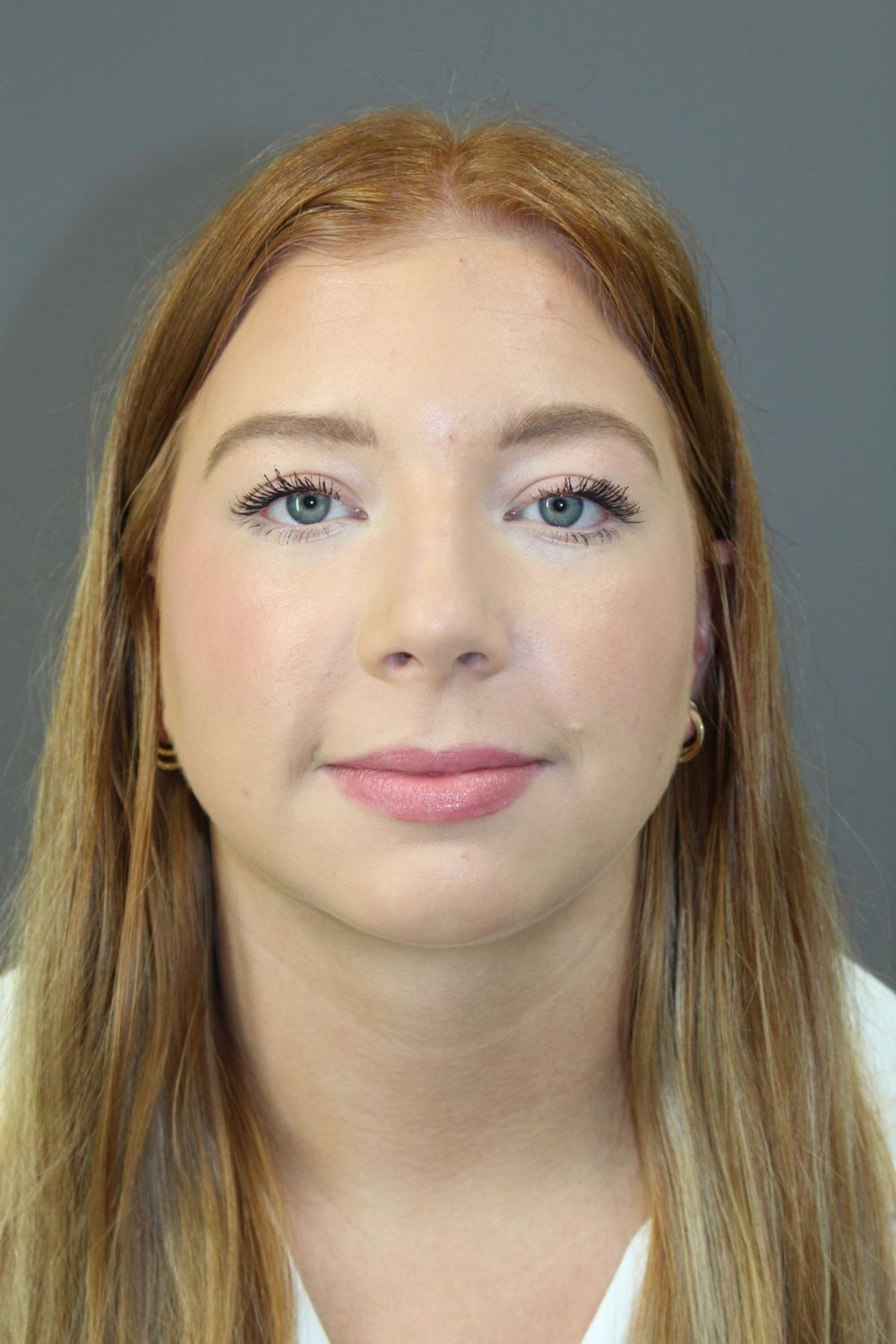 Neck Liposuction Before & After