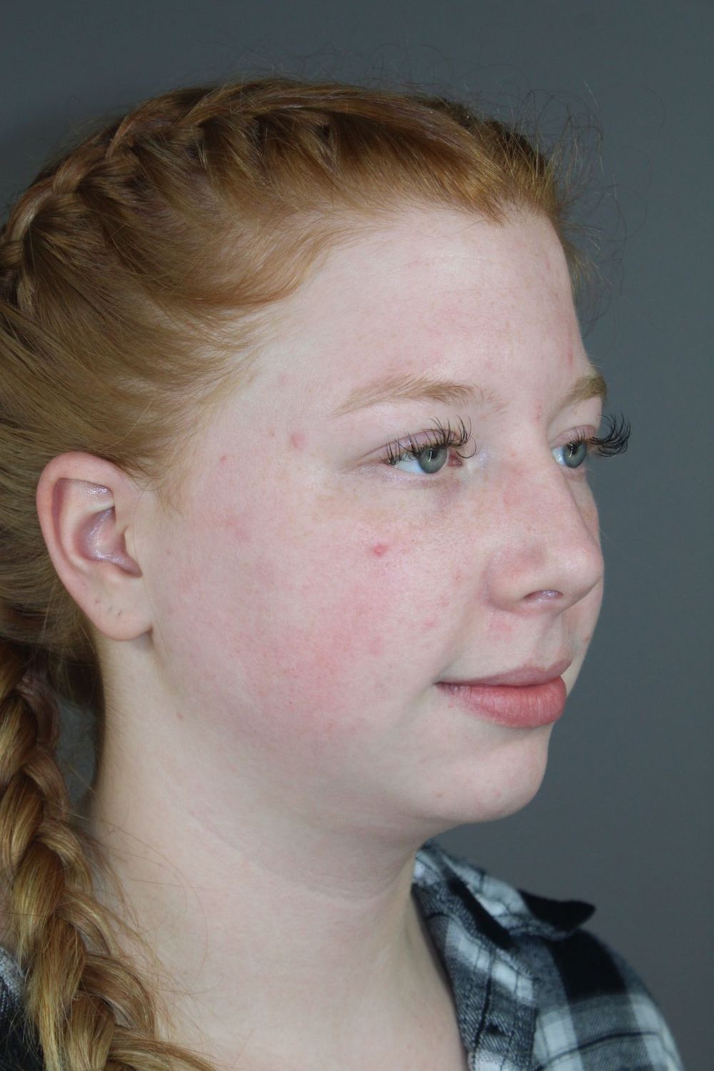 Neck Liposuction Before & After