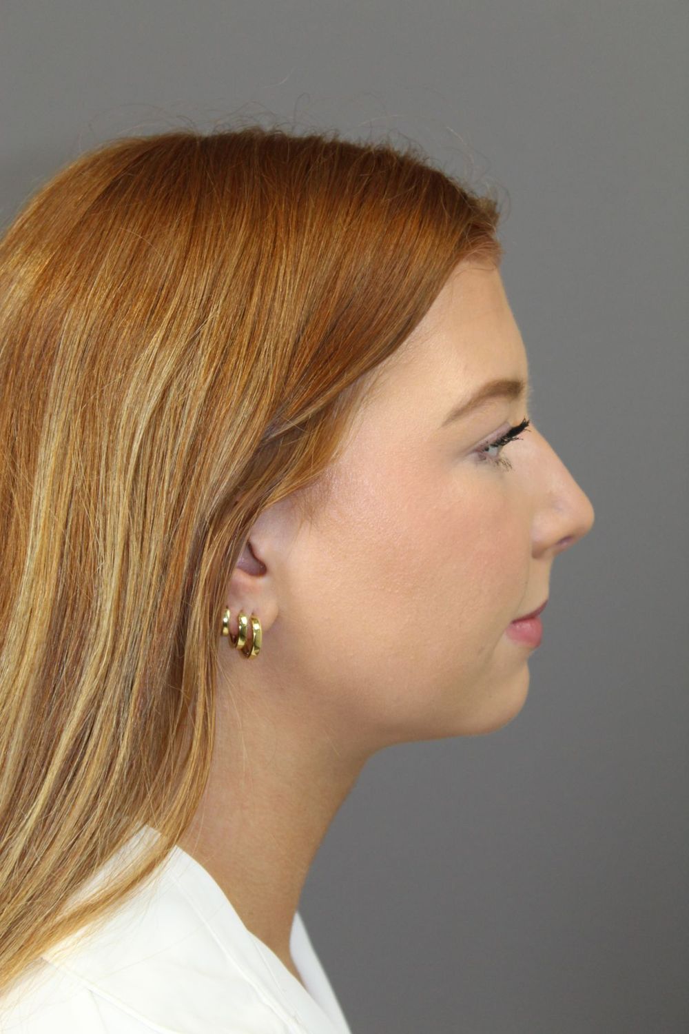 Neck Liposuction Before & After