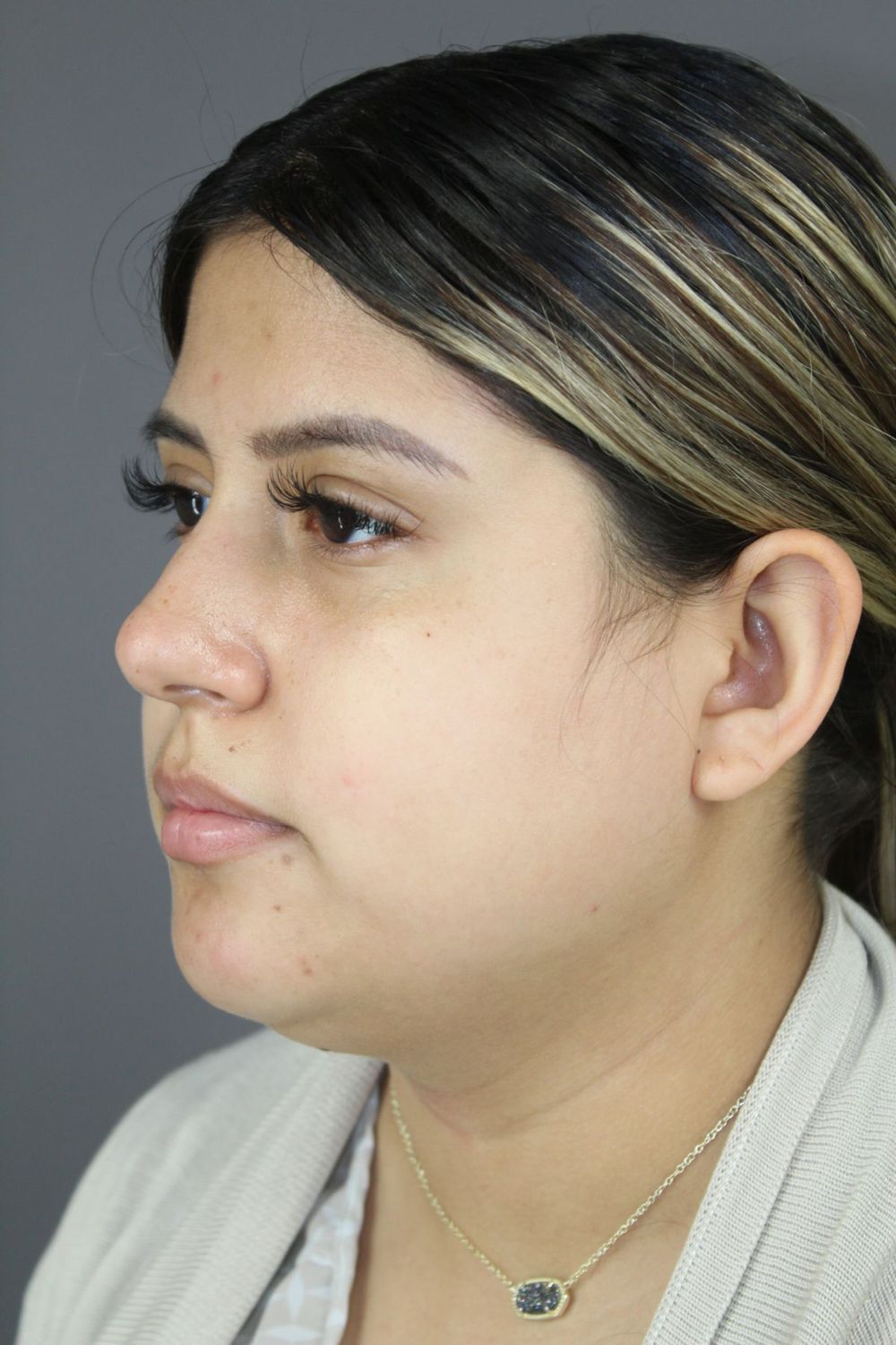 Neck Liposuction Before & After