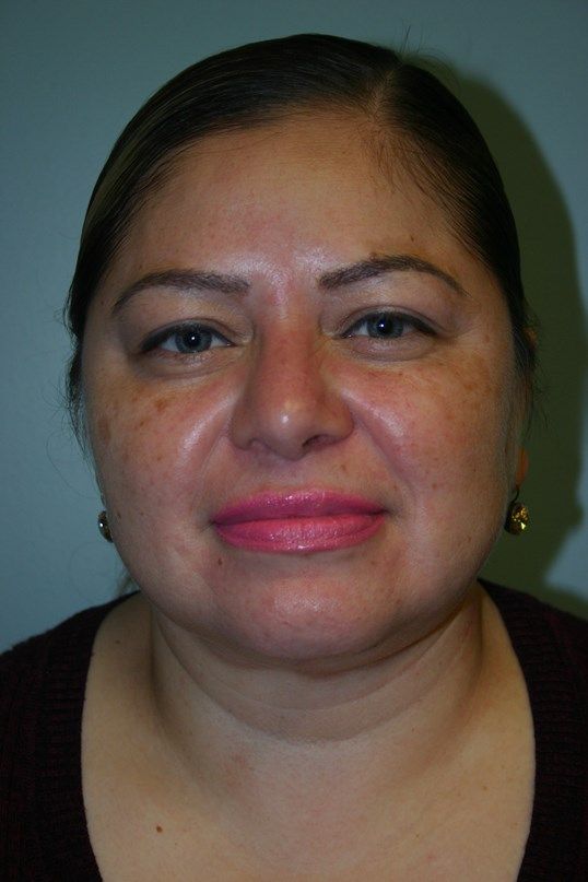 Neck Liposuction Before & After