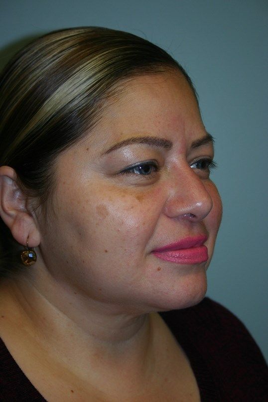 Neck Liposuction Before & After