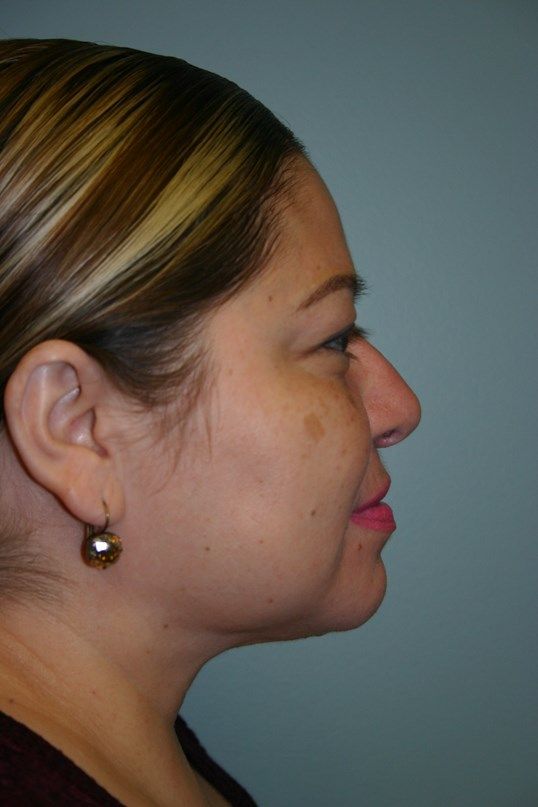 Neck Liposuction Before & After