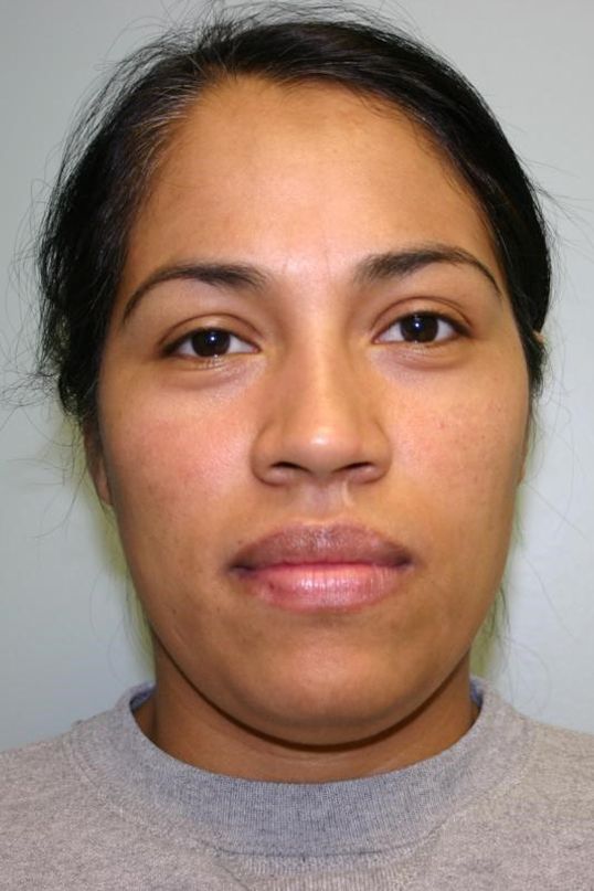 Neck Liposuction Before & After