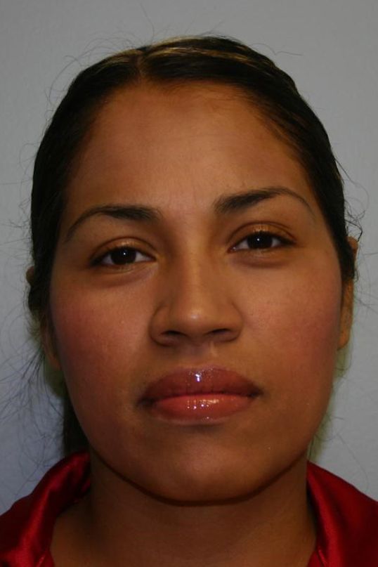 Neck Liposuction Before & After