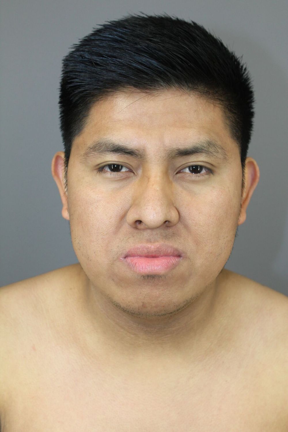 Neck Liposuction Before & After