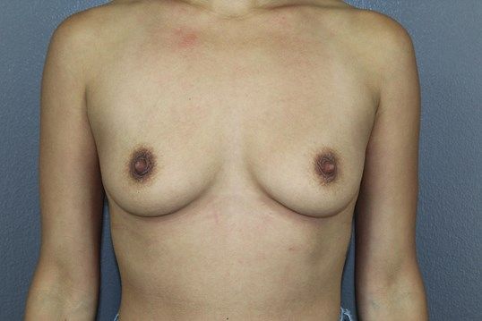 Breast Augmentation Before & After