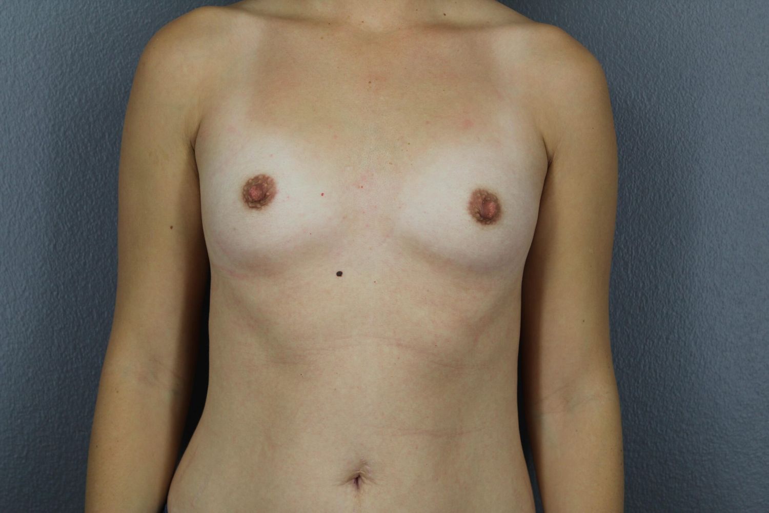 Breast Augmentation Before & After
