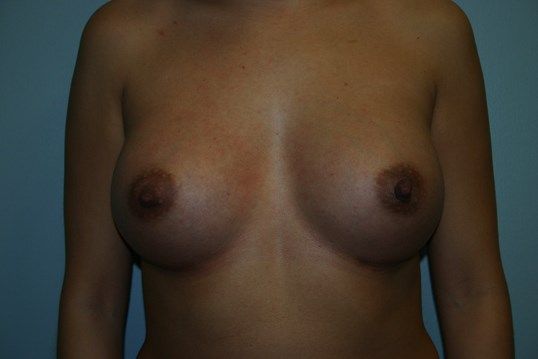 Breast Augmentation Before & After