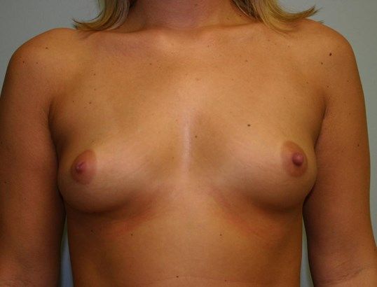 Breast Augmentation Before & After