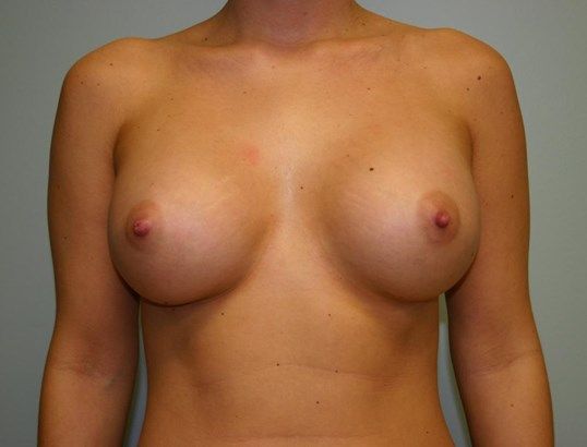 Breast Augmentation Before & After