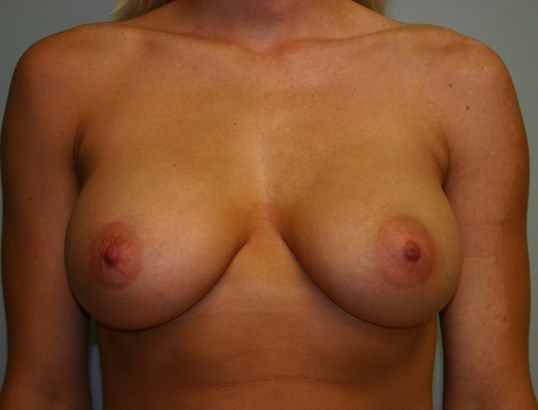 Breast Augmentation Before & After