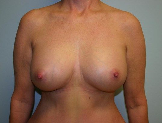 Breast Augmentation Before & After