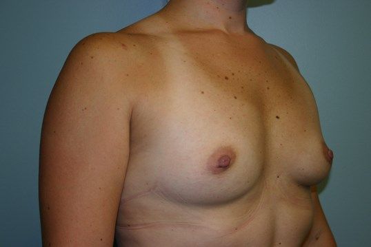 Breast Augmentation Before & After