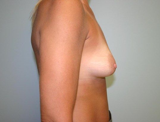 Breast Augmentation Before & After