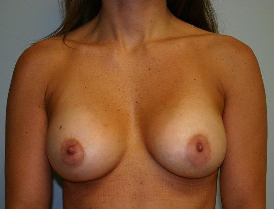 Breast Augmentation Before & After