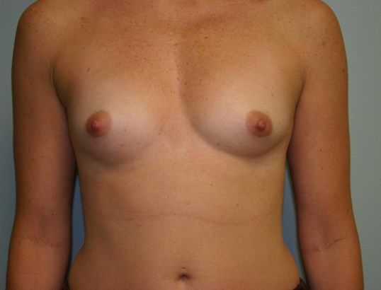 Breast Augmentation Before & After