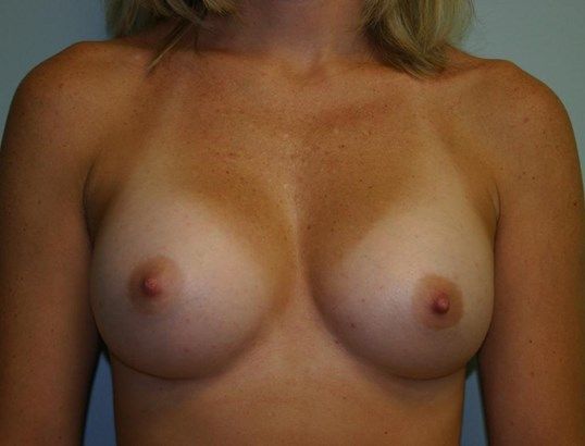 Breast Augmentation Before & After