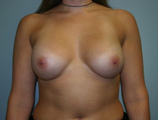 Breast Augmentation Before & After