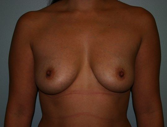 Breast Augmentation Before & After
