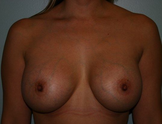 Breast Augmentation Before & After