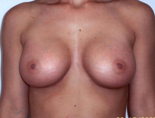 Breast Augmentation Before & After