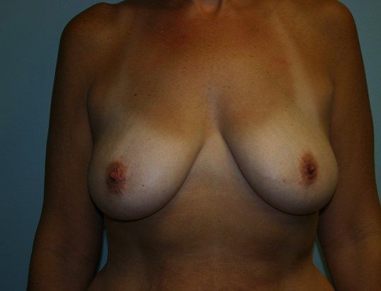 Breast Augmentation Before & After