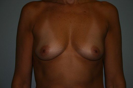 Breast Augmentation Before & After