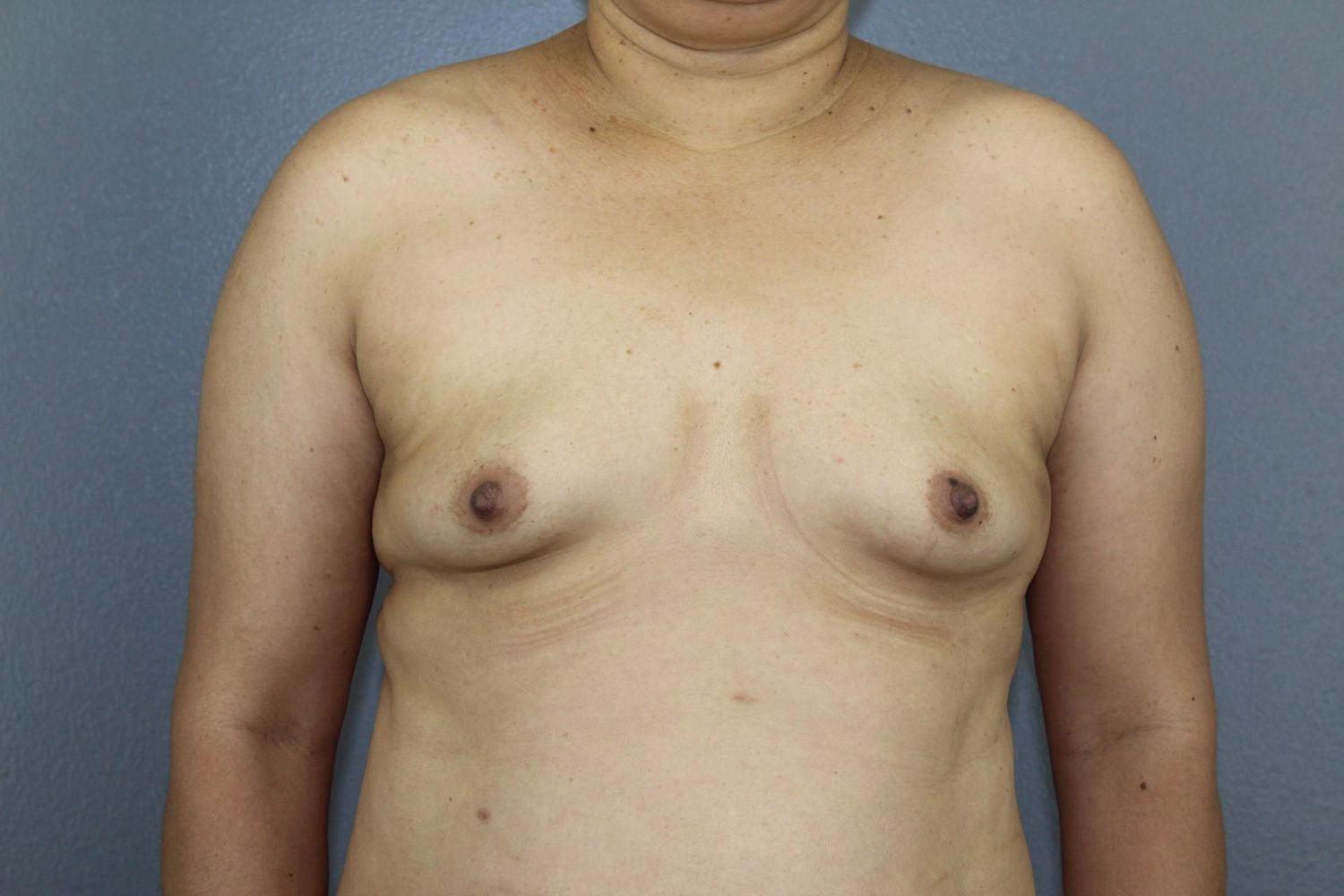 Breast Augmentation Before & After