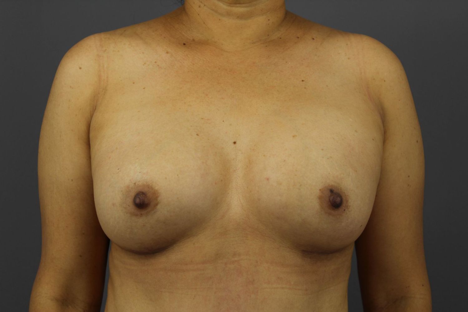 Breast Augmentation Before & After