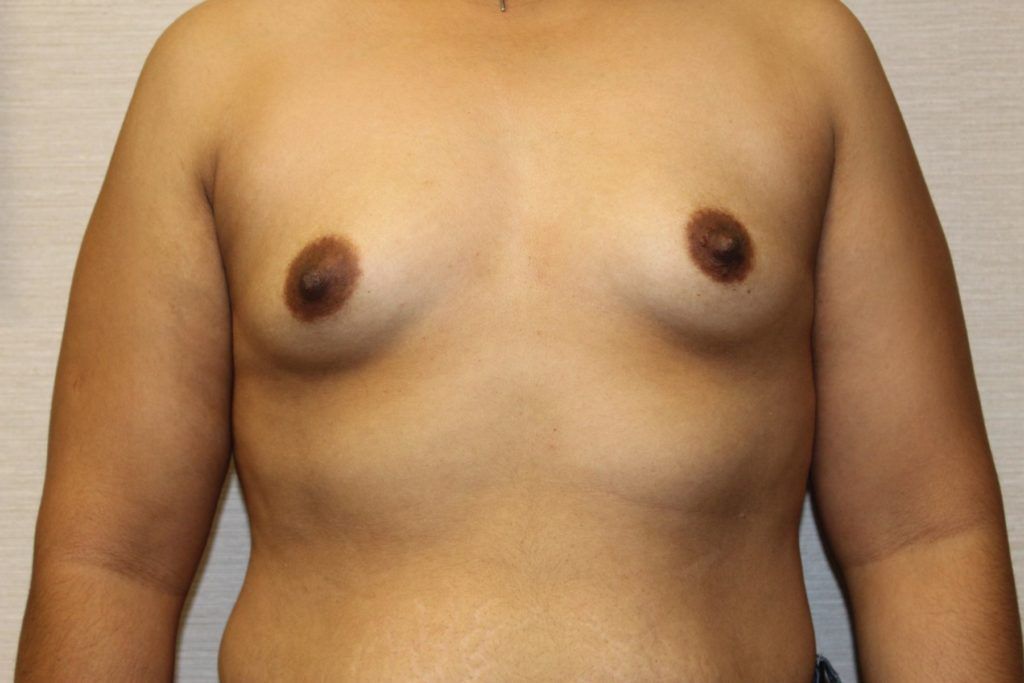Breast Augmentation Before & After