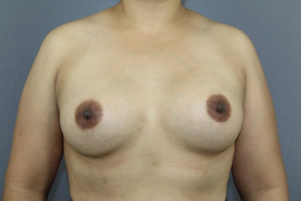 Breast Augmentation Before & After