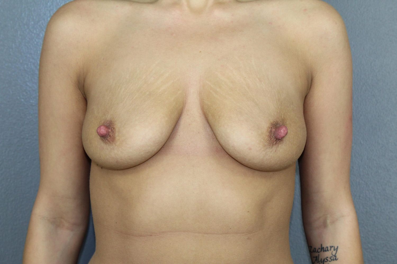 Breast Augmentation Before & After