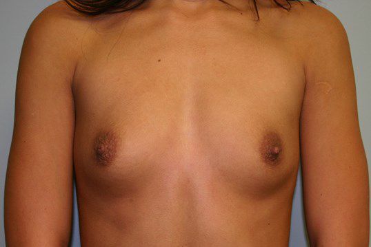 Breast Augmentation Before & After
