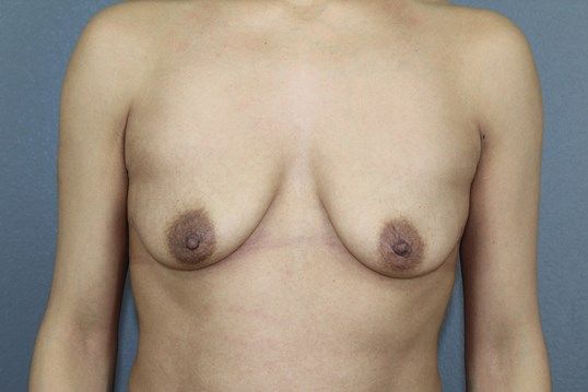 Breast Augmentation Before & After