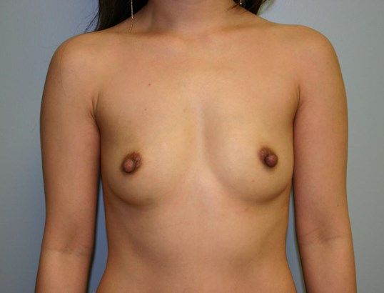 Breast Augmentation Before & After