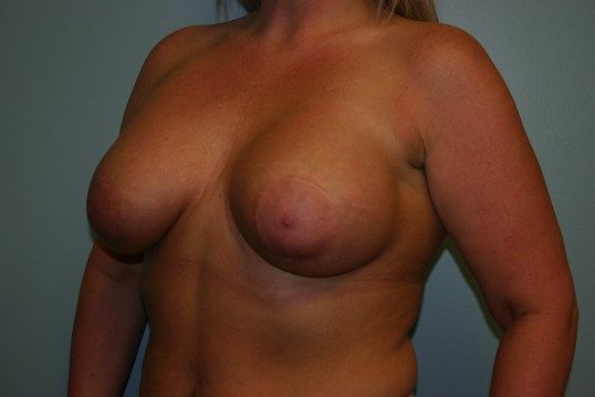 Breast Augmentation Before & After