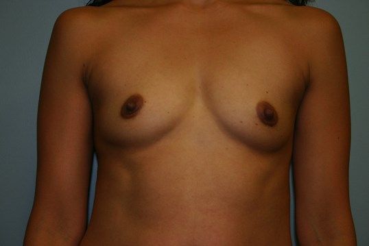 Breast Augmentation Before & After