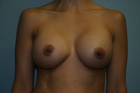 Breast Augmentation Before & After