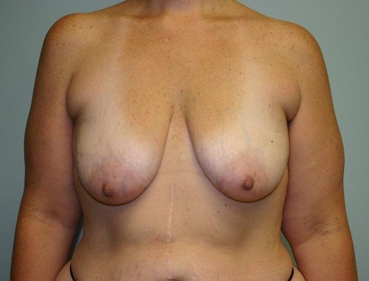 Breast Augmentation Before & After